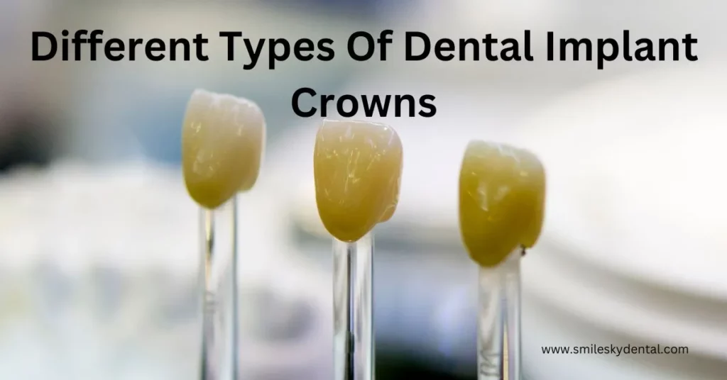 Different-Types-Of-Dental-Implant-Crowns