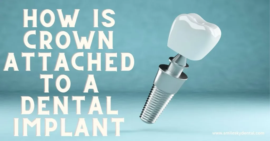 How Is Crown Attached To A Dental Implant