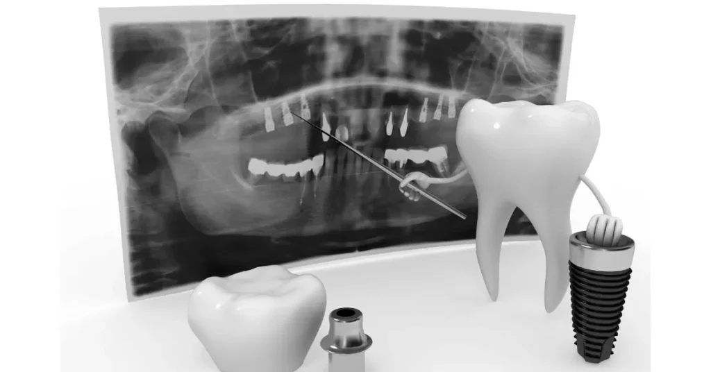 Natural-Looking-Dental-Implants