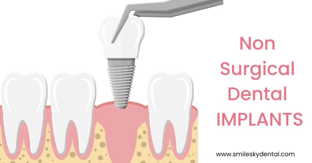 Non Surgical Dental Implants