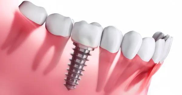 Pre-Dental Implant Surgery Instructions