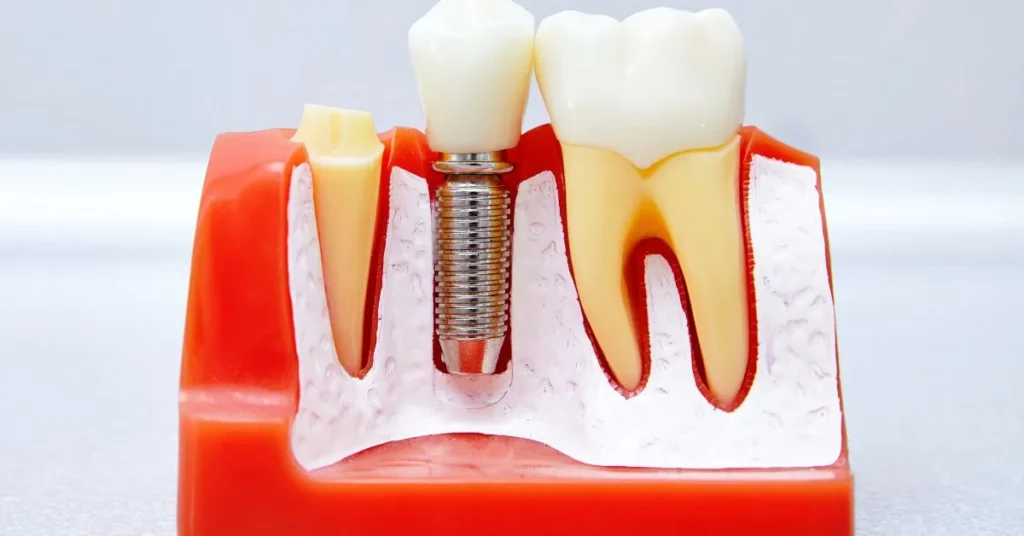 Reasons-For-Removing-A-Dental-Implant