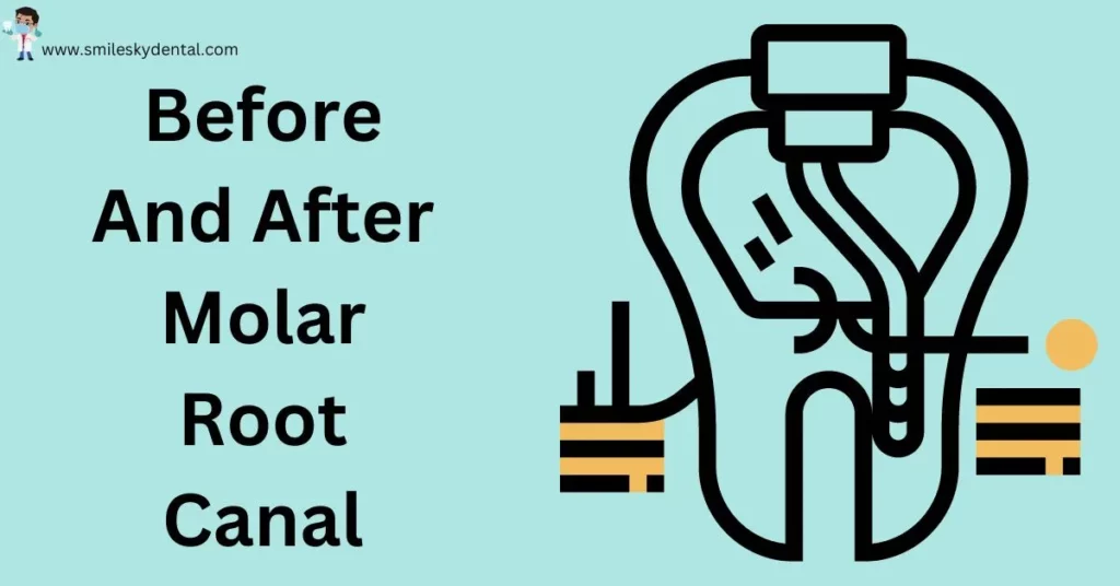 Before-And-After-Molar-Root-Canal (1)