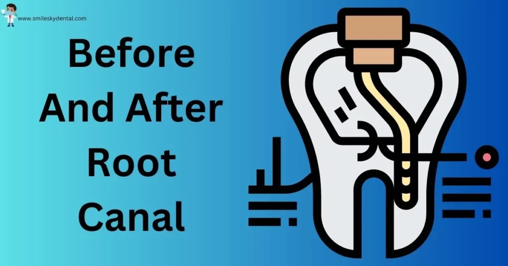 Before-And-After-Root-Canal