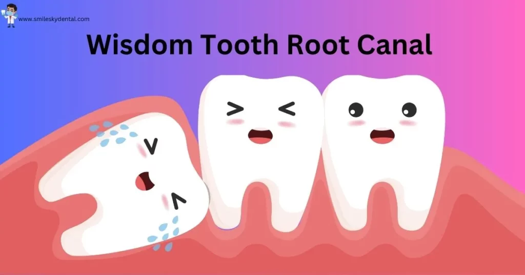 Wisdom Tooth Root Canal