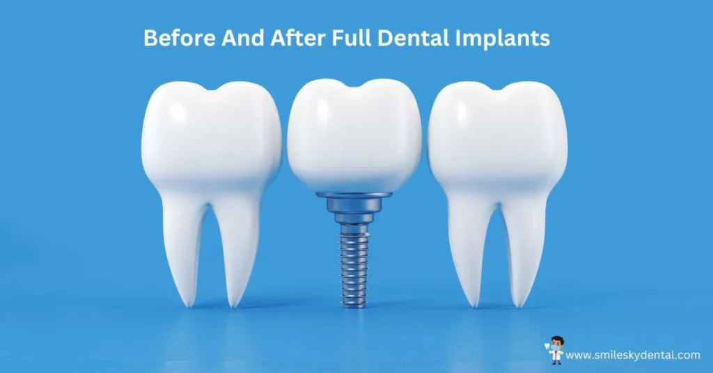 Before-And-After-Full-Dental-Implants