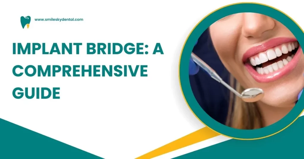 Implant-Bridge_-A-Comprehensive-Guide