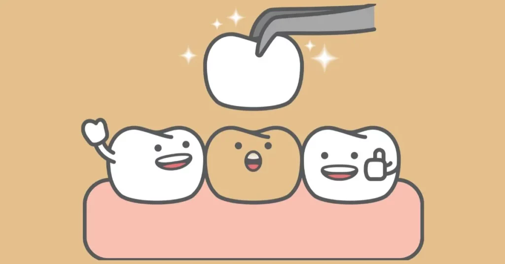 Wisdom-Teeth-Implants-vs.-Dental-Implants