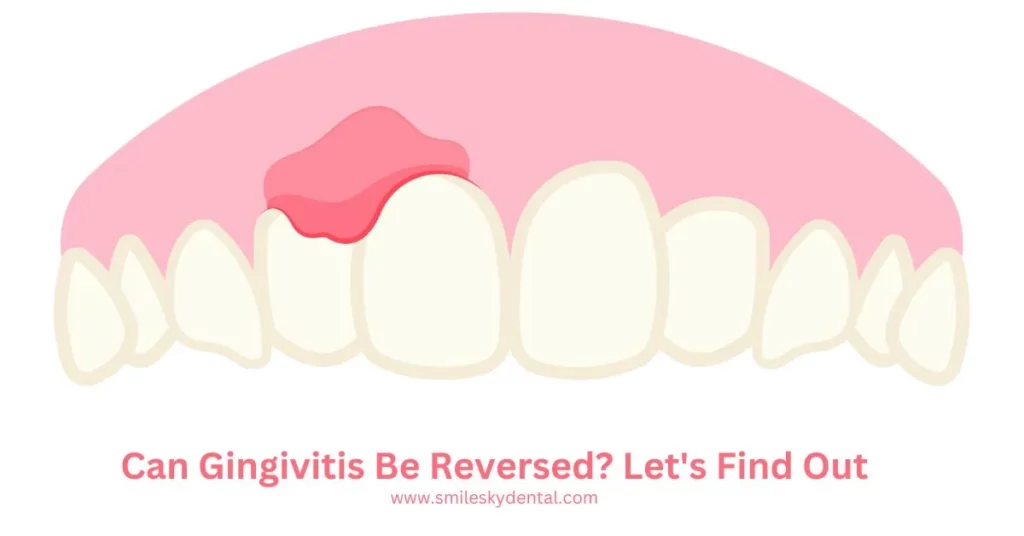 Can-Gingivitis-Be-Reversed-Let_s-Find-Out