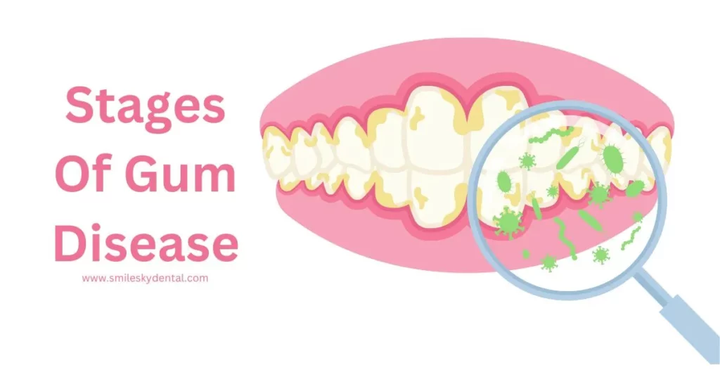 Stages-of-Gum-Disease-Important-Symptoms