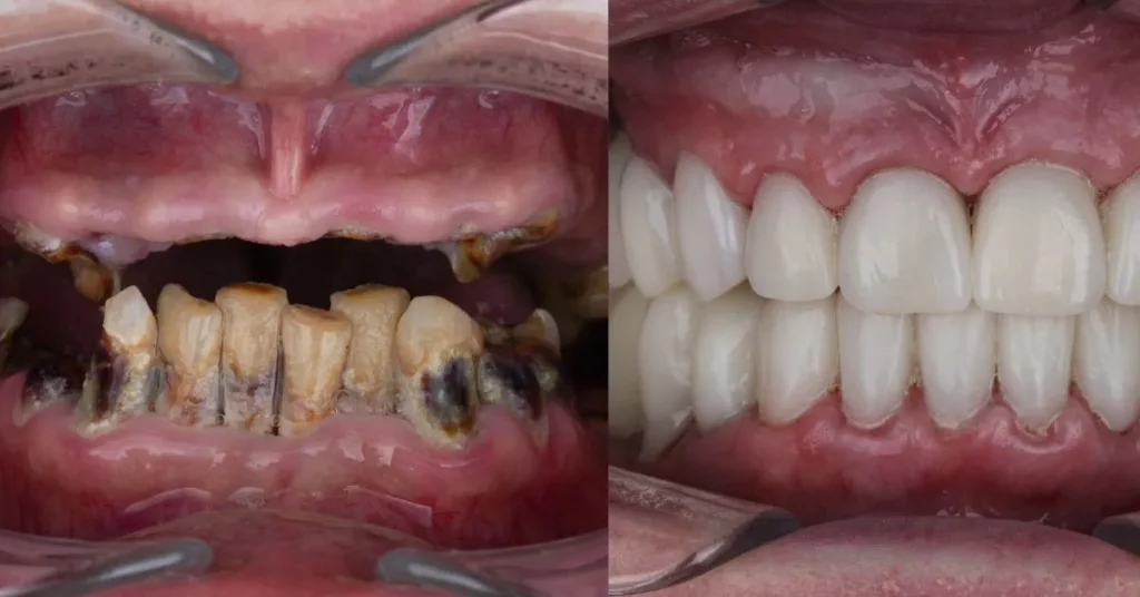 Before-and-after-shot-of-a-temporary-dental-bridge