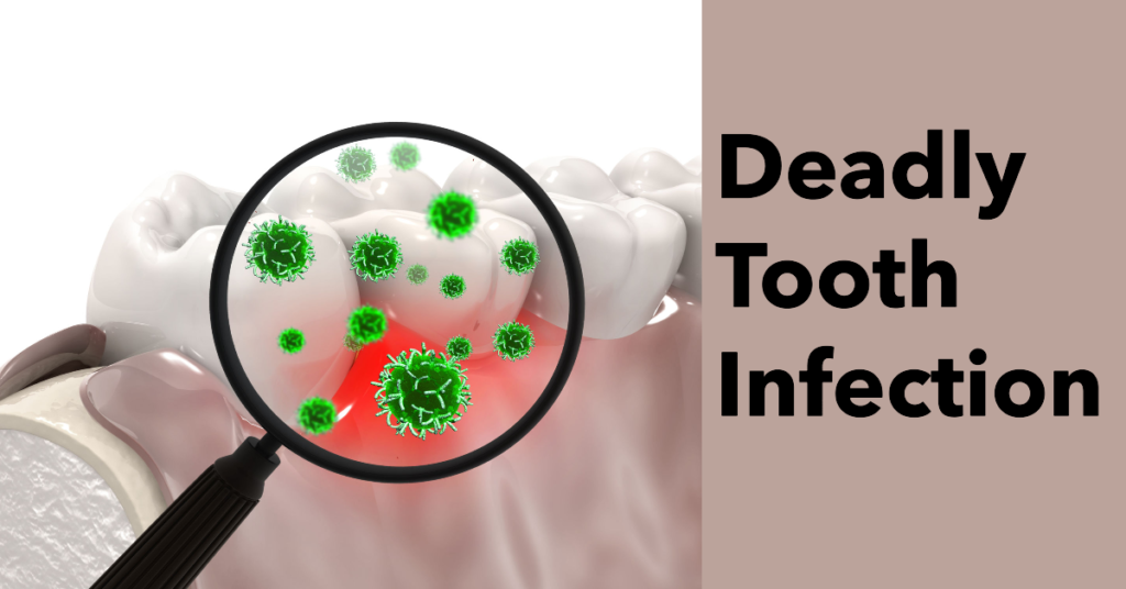 Deadly-Tooth-Infection-Most-Common-Concerns