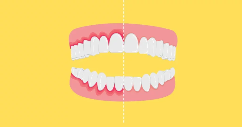 How-Long-Does-It-Take-Gingivitis-to-Progress-to-Periodontitis