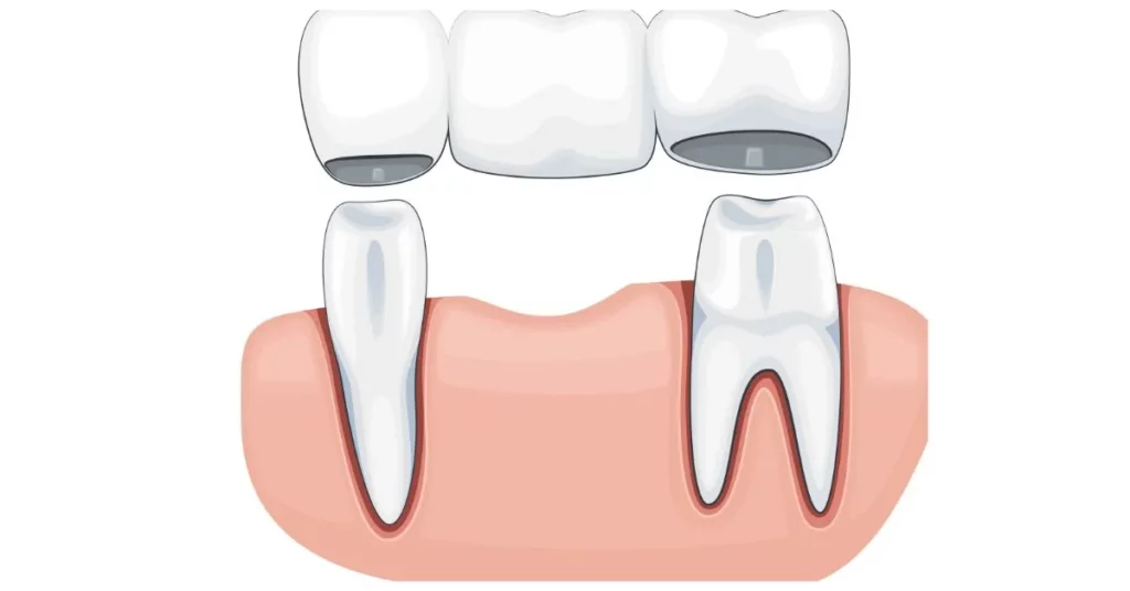 Image-1_-A-temporary-dental-bridge-in-position-1