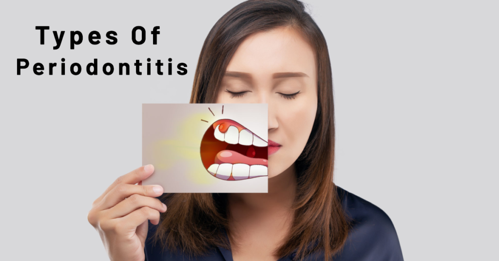 Types-of-Periodontitis