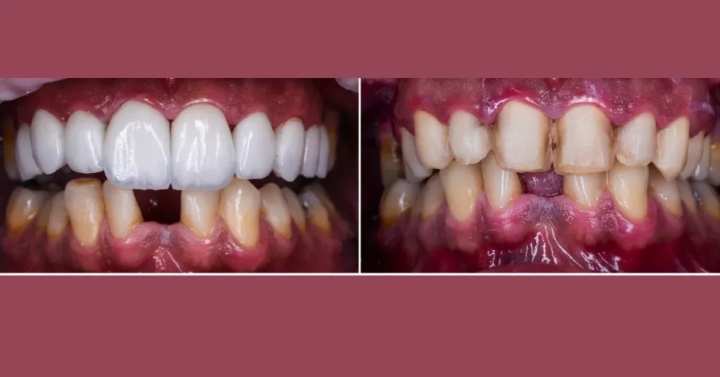 Front-Teeth-Fillings-Before-and-After